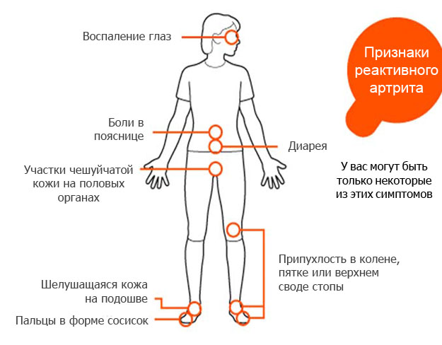 Реактивные артриты презентация